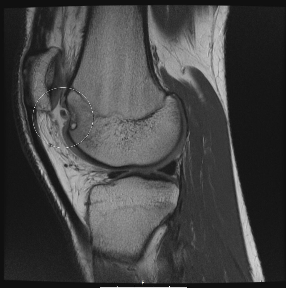MRI image of an osteochondritis dissecans (OCD) lesion in the trochlea — a circled area with a depressed defect containing a loose fragment in the knee of an 18-year-old man.