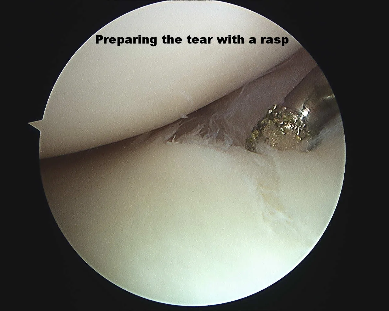 Intra-operative arthroscopic image of meniscal repair