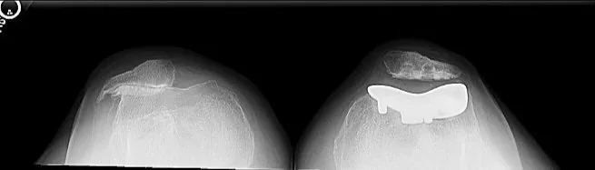 Bilateral knee X-ray showing patellofemoral replacement on the right and patellofemoral arthritis on the left