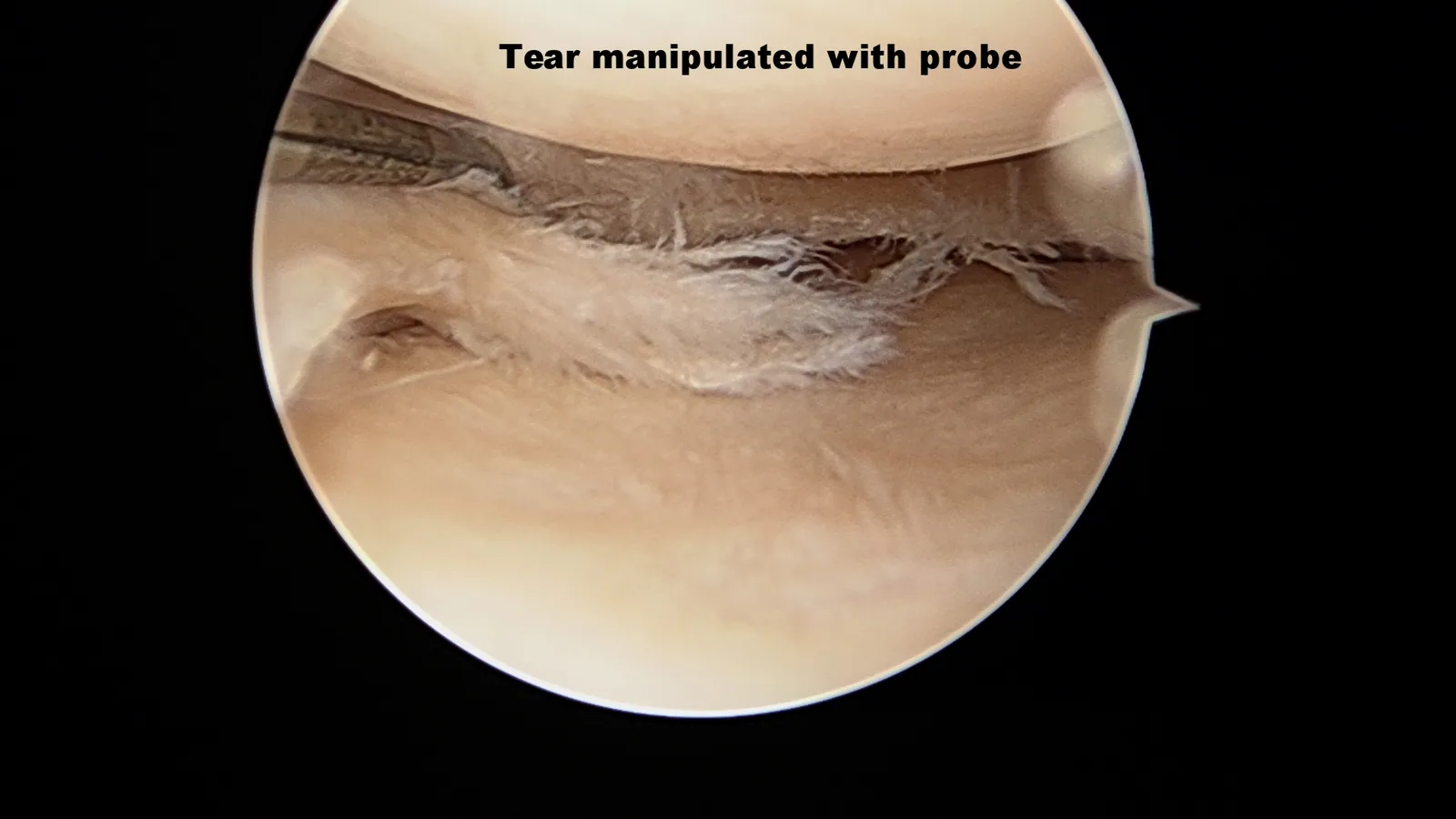 Intra-operative arthroscopic image of meniscectomy