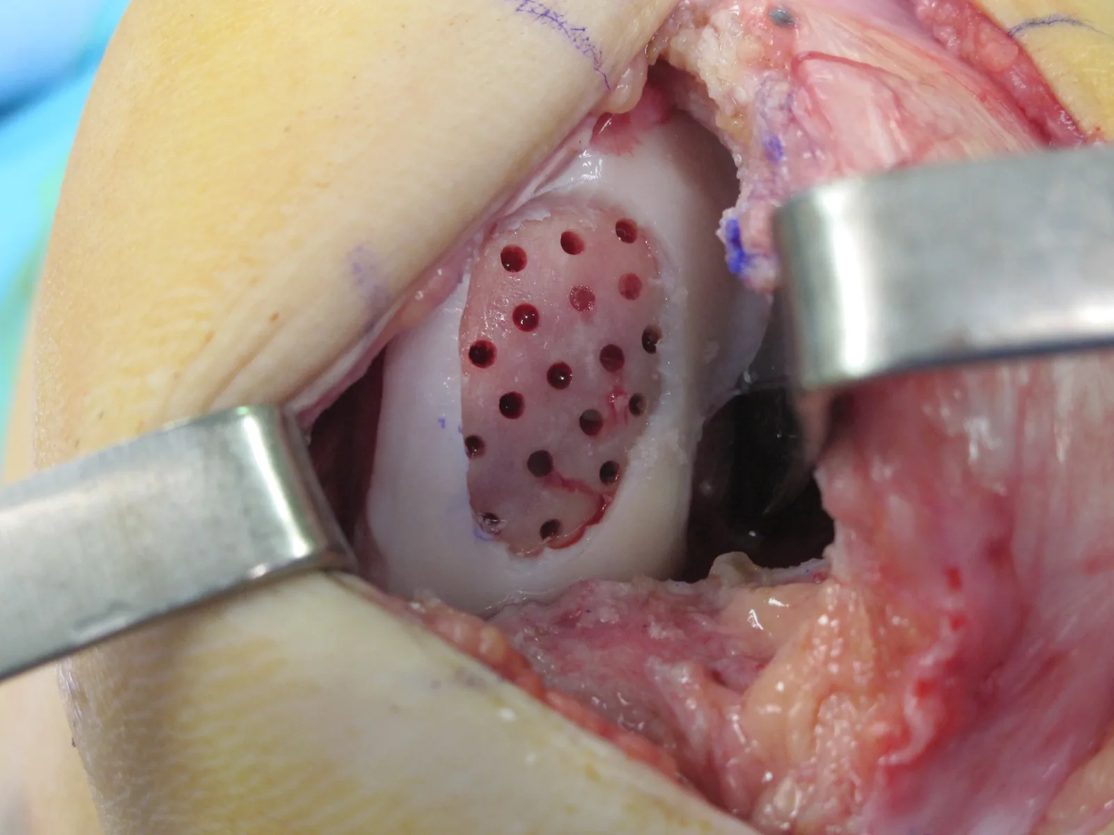 Cartilage defect after subchondral drilling