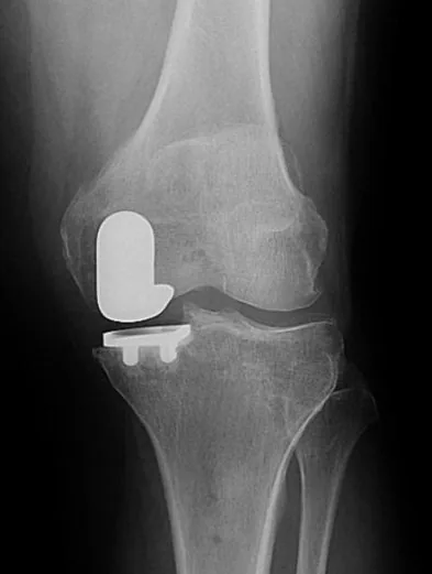 Left knee X-ray after medial partial knee replacement
