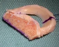 Intra-operative arthroscopic image of meniscal transplantation