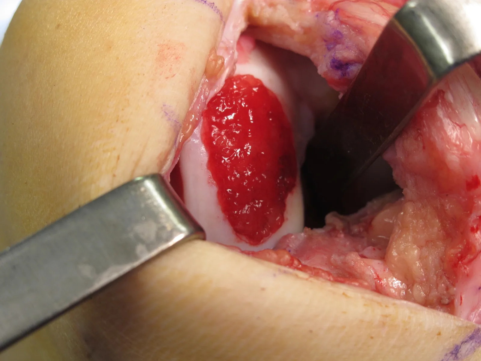 Umbilical cord blood mesenchymal stem-cell implantation