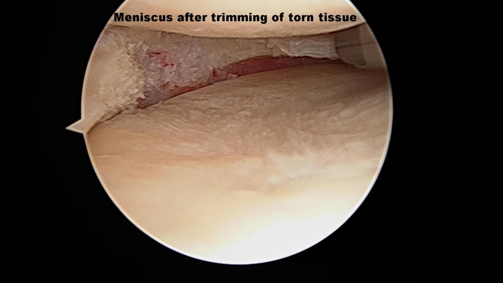 Intra-operative arthroscopic image of meniscectomy