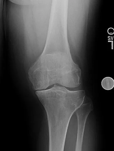 Bilateral knee X-ray showing medial compartment bone-on-bone arthritis on one side
