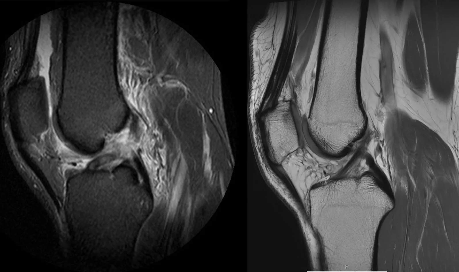Sagittal MRI comparison: outside image (left) versus HSS MRI (right) showing higher resolution