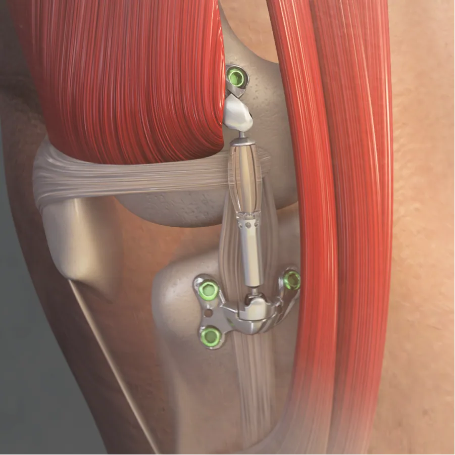 Rendering of the MISHA medial implantable shock absorber on the knee