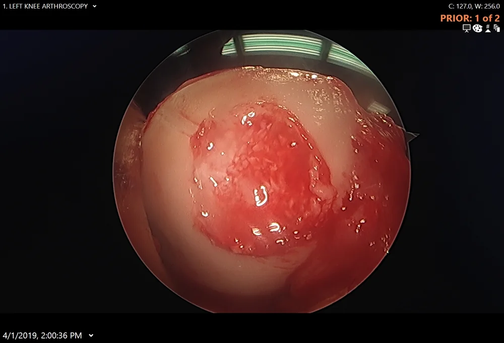 Arthroscopic view of the patellar defect after preparation and filling with the DeNovo tissue graft