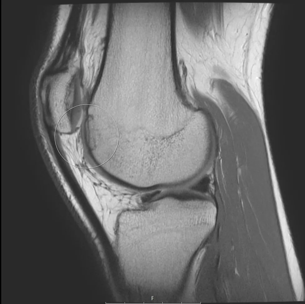 MRI of the same trochlear defect 6 months after osteochondral allograft transplantation showing nearly complete graft integration